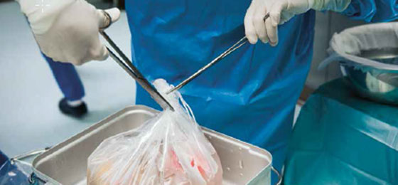 eine gespendete Leber für eine Organtransplantation © Keystone/Laif/Dominik Butzmann